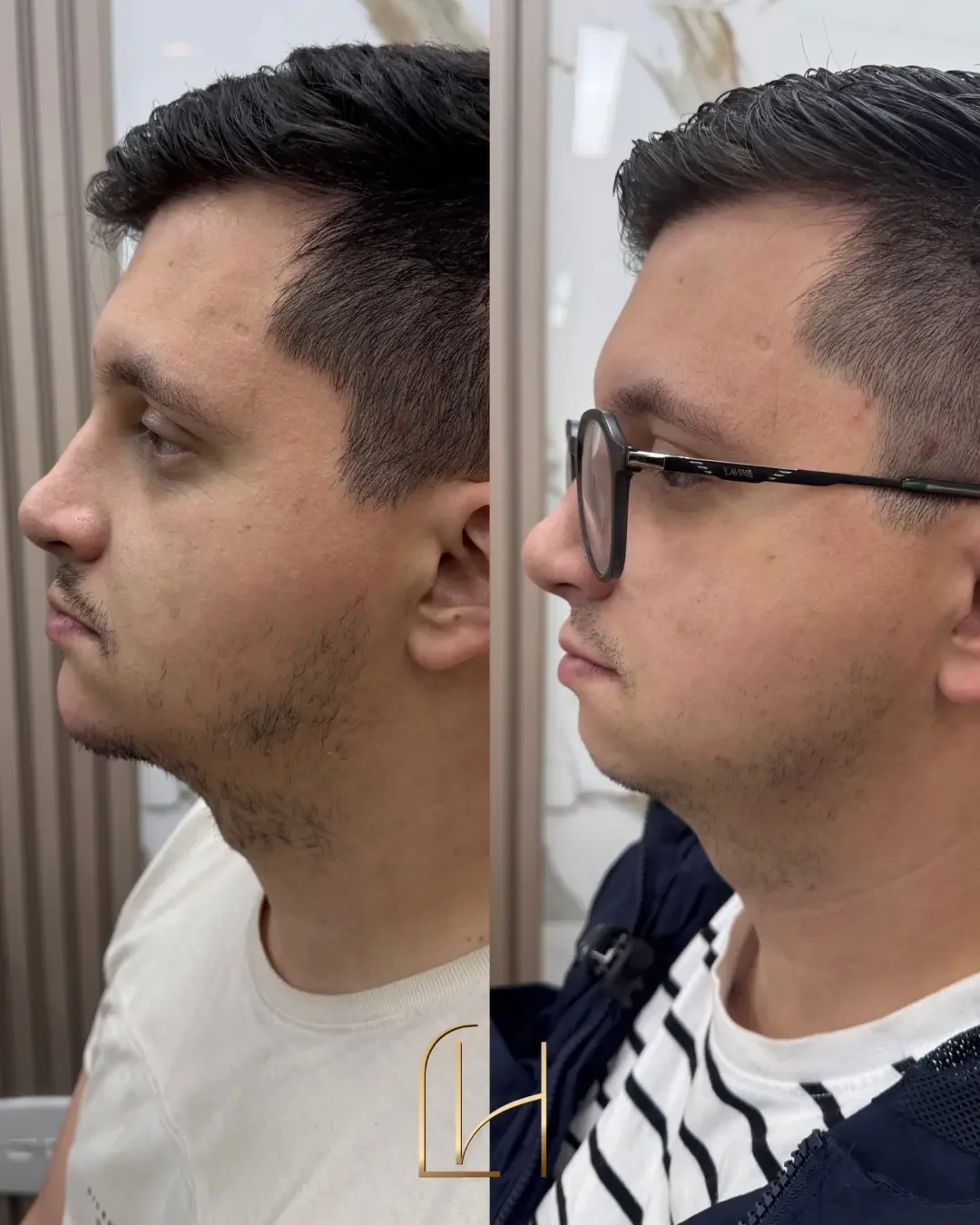 Antes e depois de harmonização masculina: o mesmo paciente de perfil, à esquerda antes e à direita depois