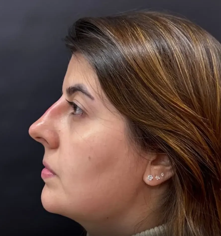 Depois: a mesma paciente de perfil, três meses após a lipo de papada, com o contorno do maxilar mais definido