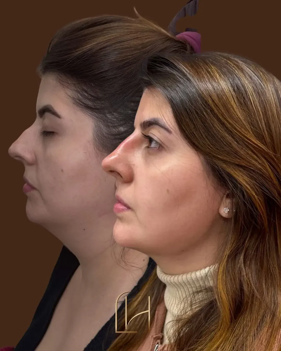 Antes e depois de lipo de papada: a mesma paciente de perfil, à esquerda antes e à direita três meses depois, com o contorno do queixo e do pescoço mais definido